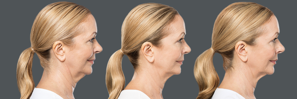 kybella treatment progression on blonde woman with ponytail