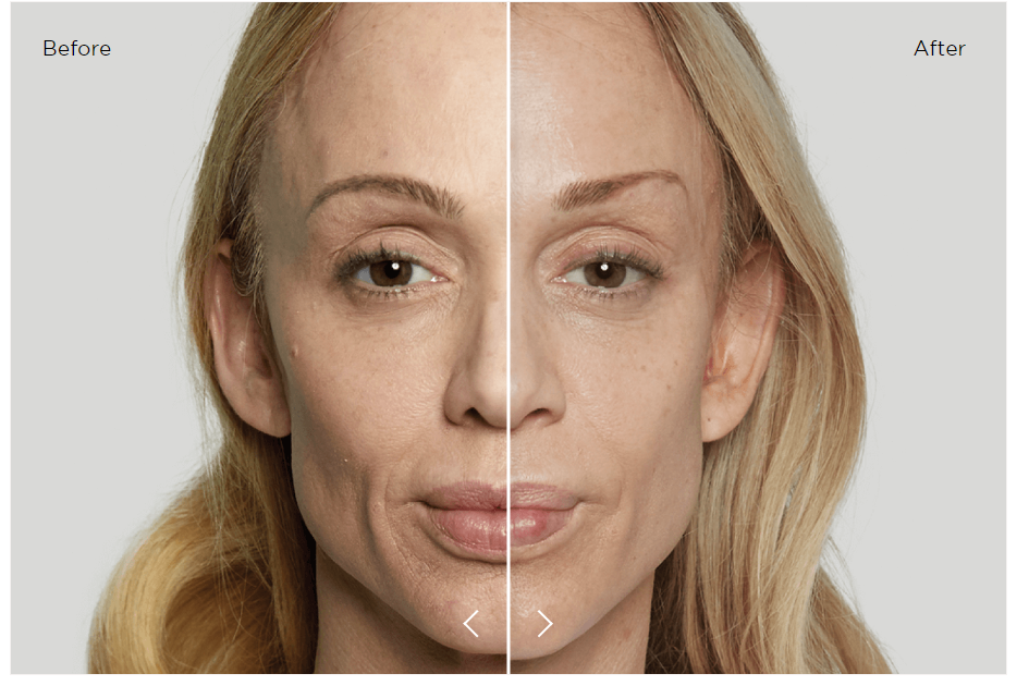 before and after sculptra