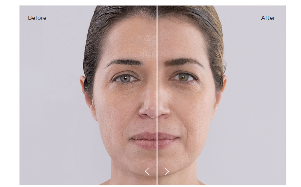 brunette woman before and after sculptra treatments