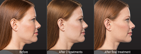 kybella treatment progression on redheaded woman