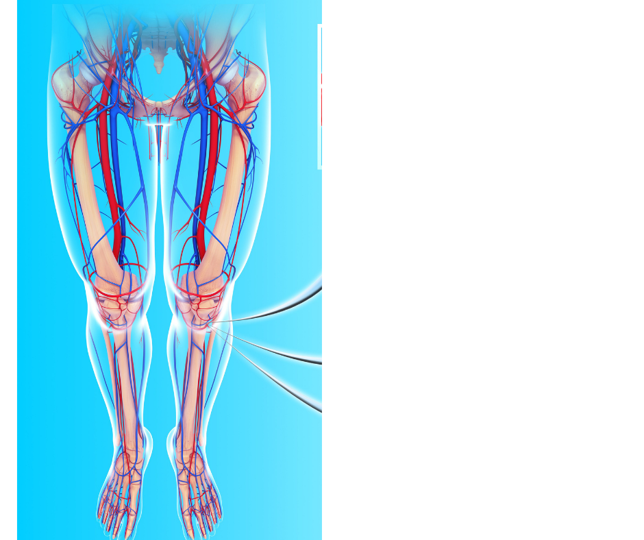 what-is-peripheral-artery-disease-and-how-does-it-relate-to-stroke