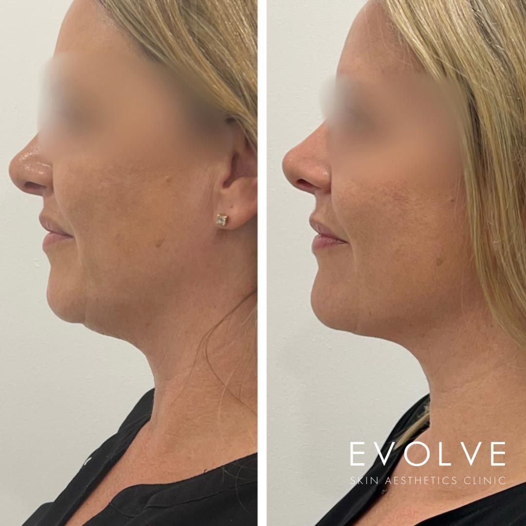 Before and after profile view of a woman's neck and jawline, showing skin tightening after a procedure.