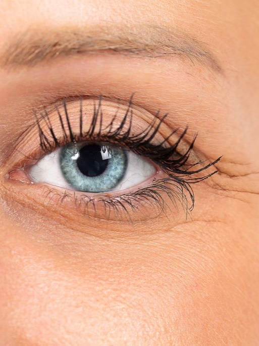 Close up of womans eye showing wrinkle treatment