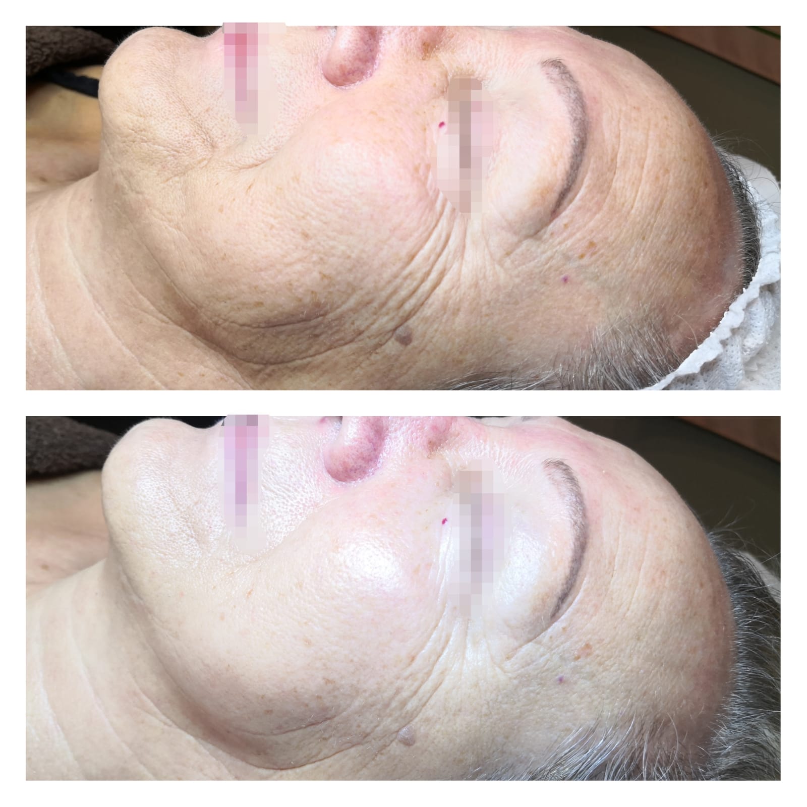 prima e dopo pelle secca