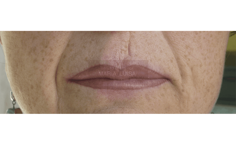 Prima e dopo di ricostruzione labbra con sfumatura effetto riempimento e copertura cicatrice