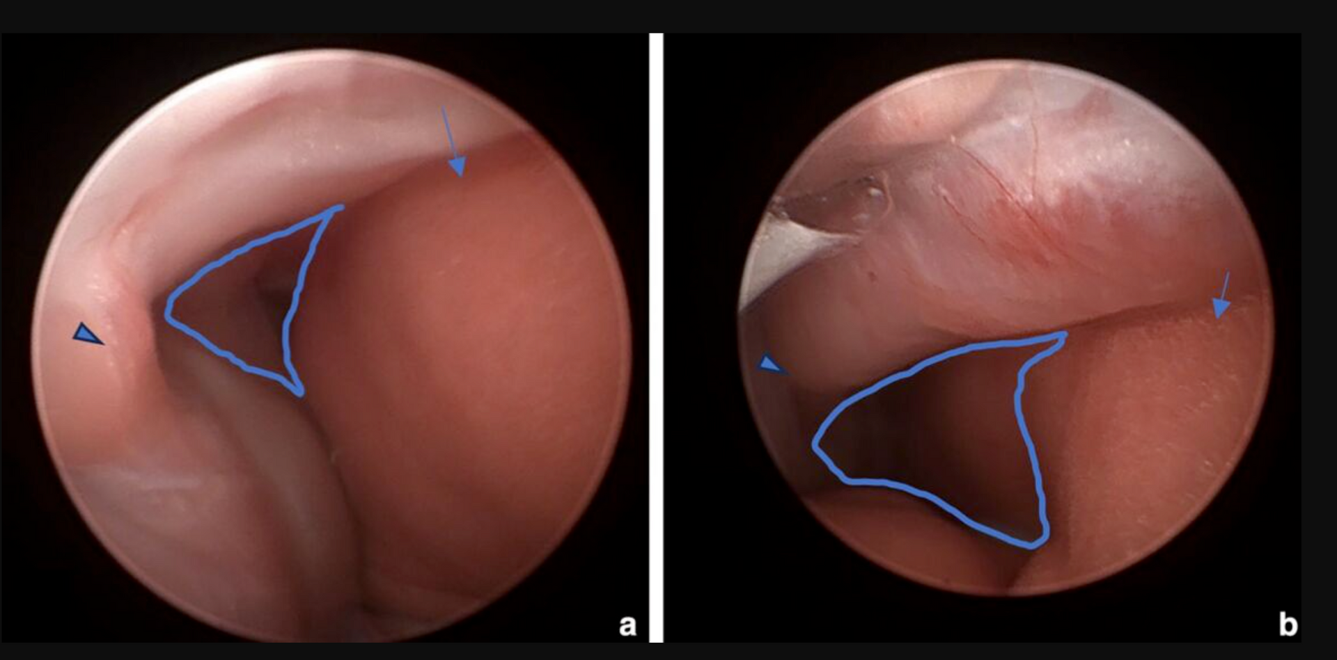 Une image de la bouche d'une personne avec une ligne bleue qui la traverse.