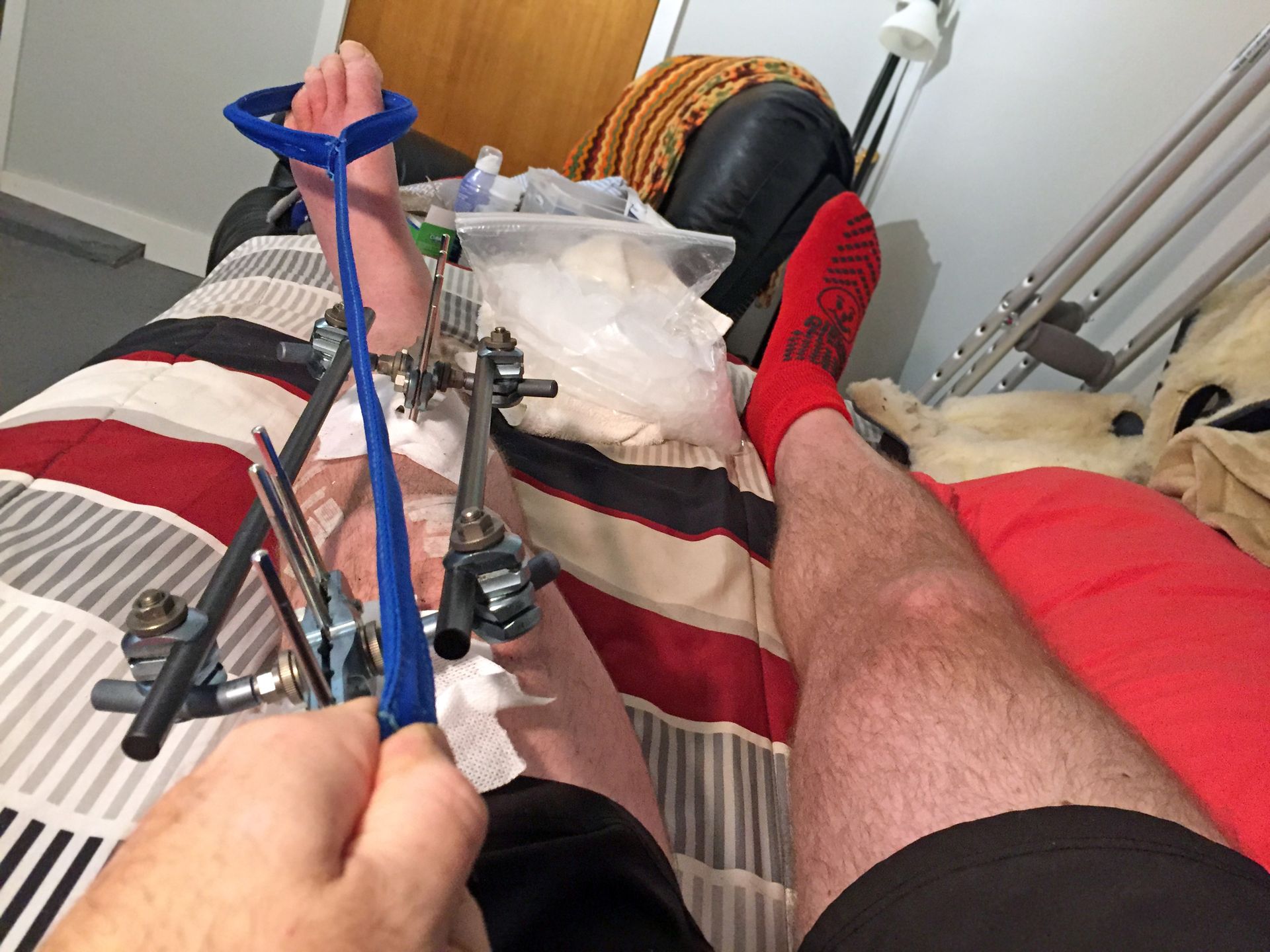 A person is laying on a bed with a broken leg in a cast.