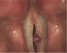 Hemorrhagic polyp surgery in Louisville, KY | Dr. Elizabeth Self Burckardt