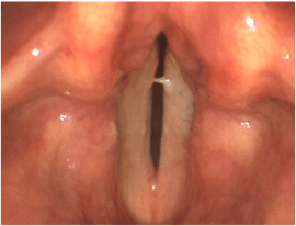 vocal cord cancer post-cancer-treatment-photo
