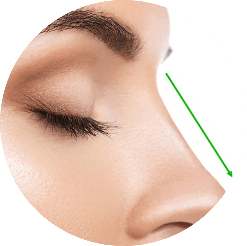 Non Surgical Rhinoplasty After