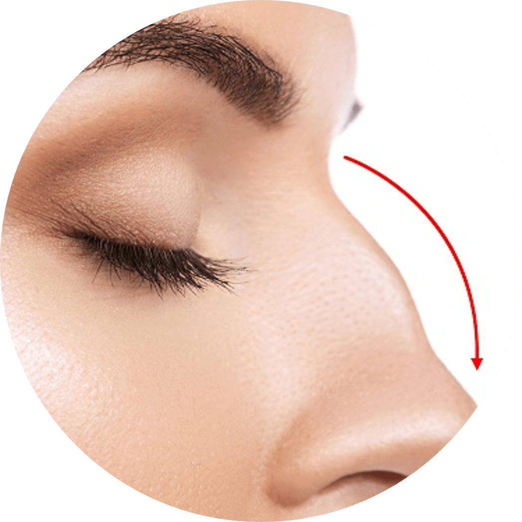 Non Surgical Rhinoplasty Before