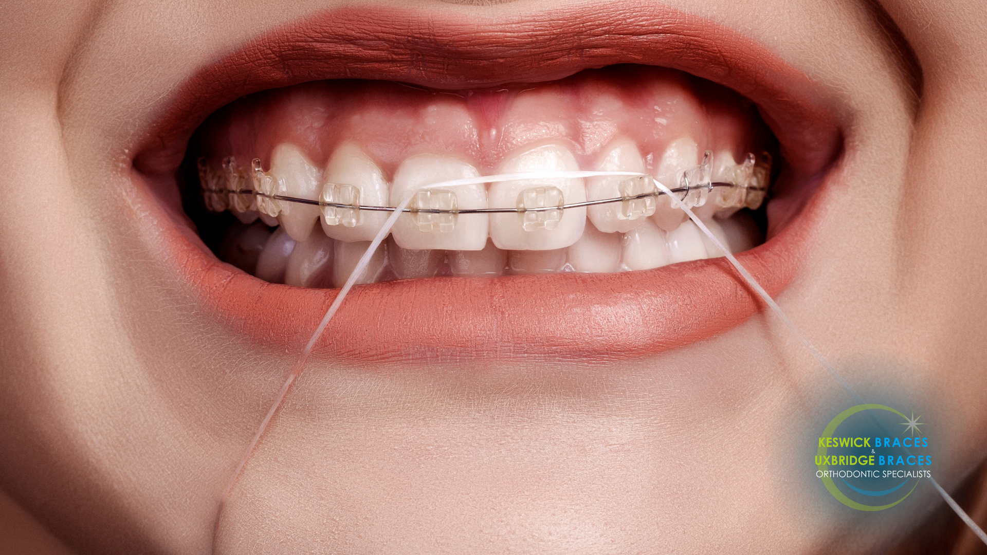 A woman with braces is flossing her teeth with a dental floss.