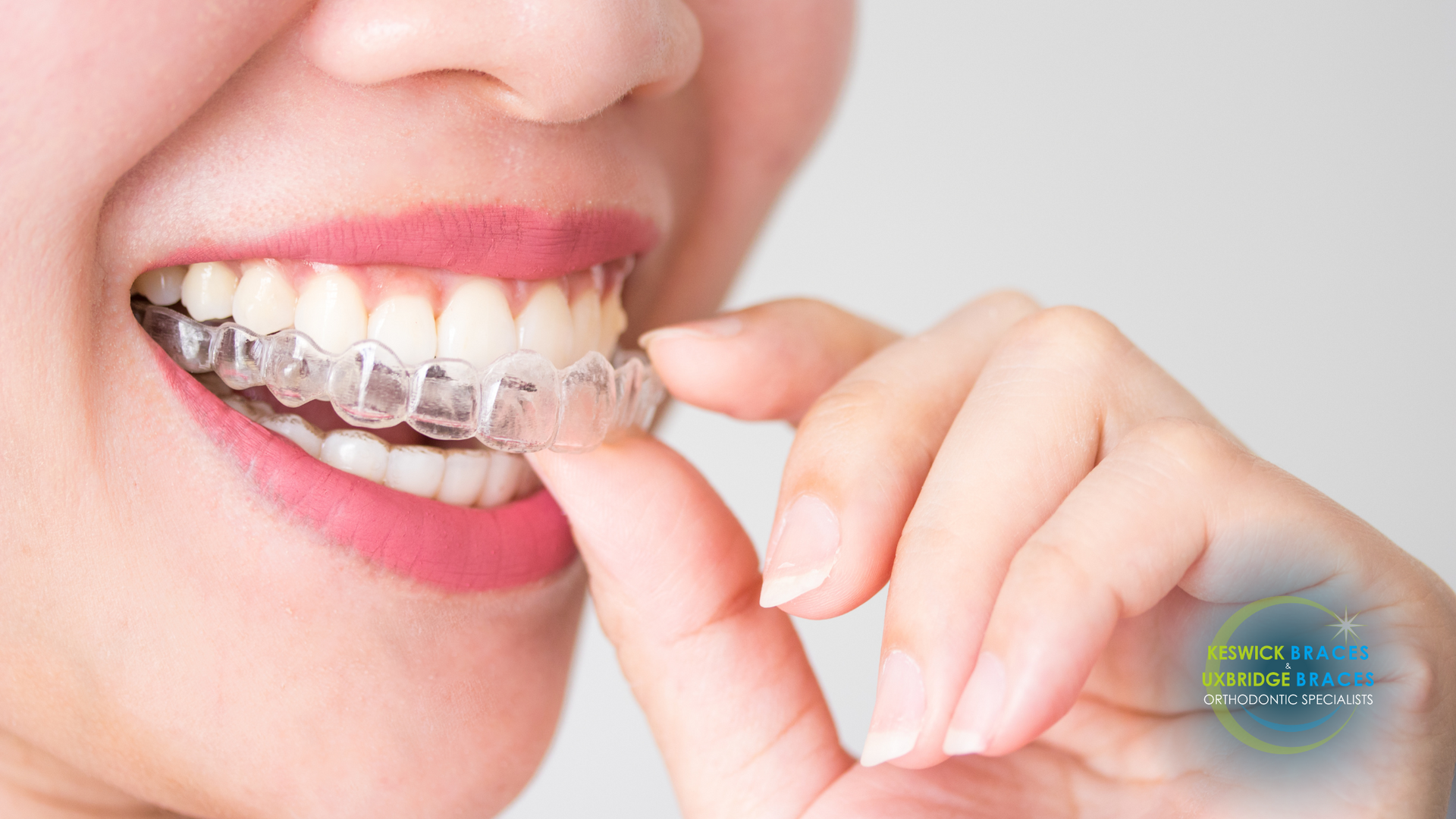 A woman is wearing a clear brace on her teeth.