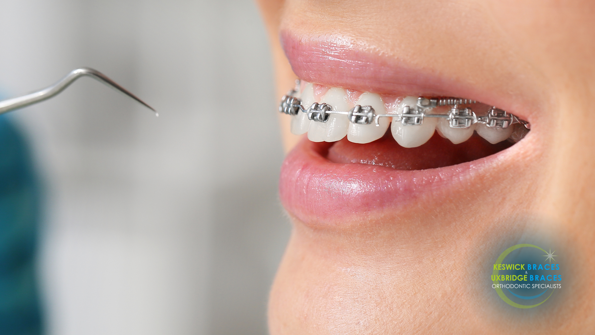 A close up of a woman 's mouth with braces on her teeth.