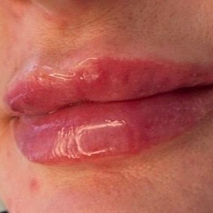 Aesthetics By Luisha | Dermal Filler In Derby, UK