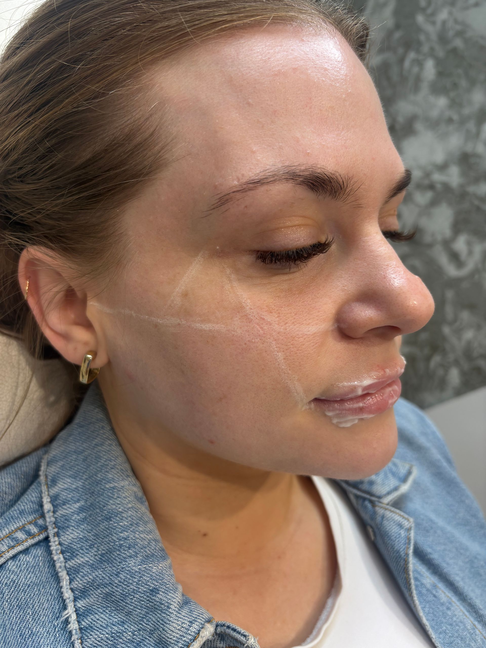 Aesthetics By Luisha | Dermal Filler In Derby, UK