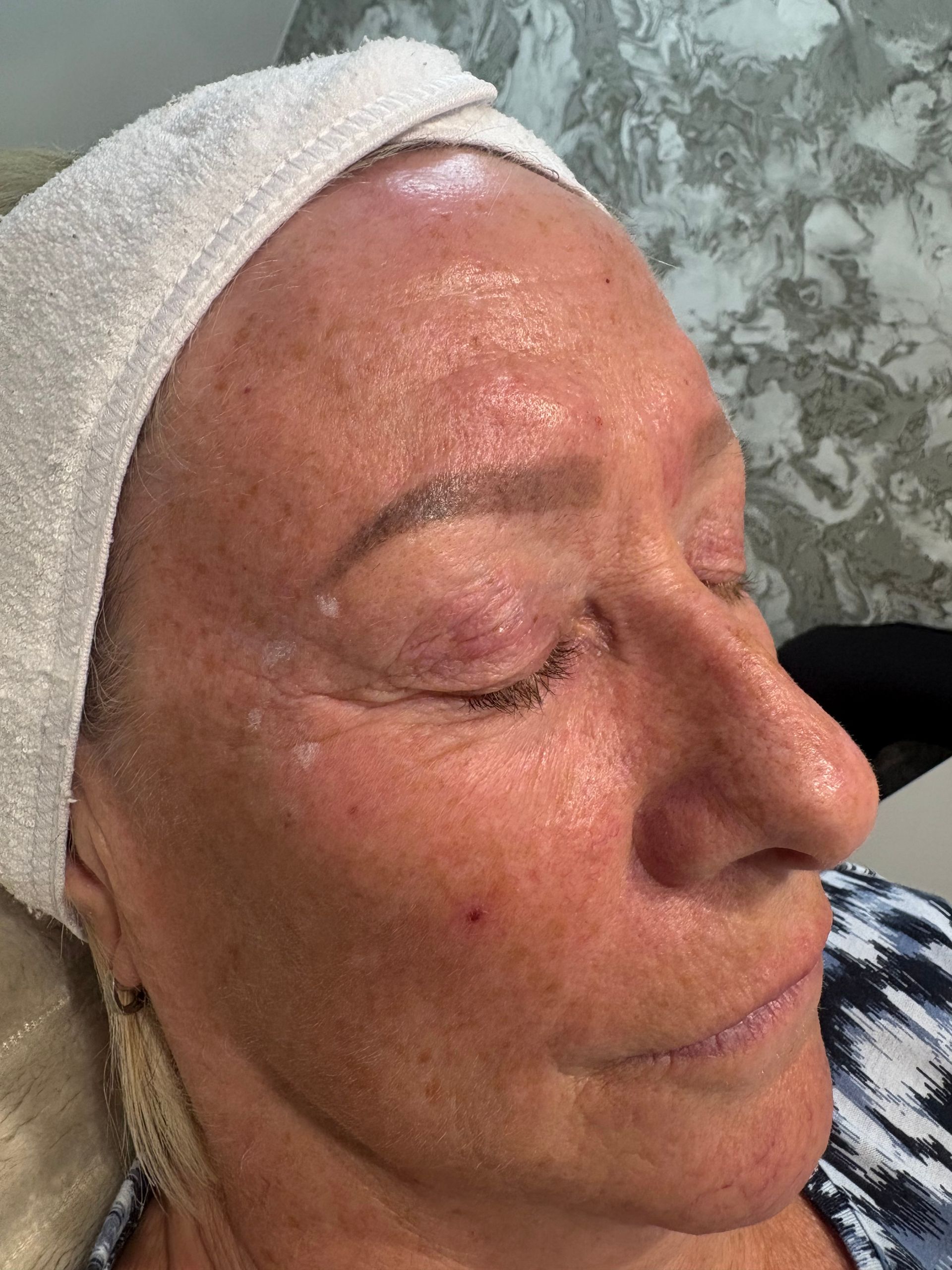 Aesthetics By Luisha | Dermal Filler In Derby, UK