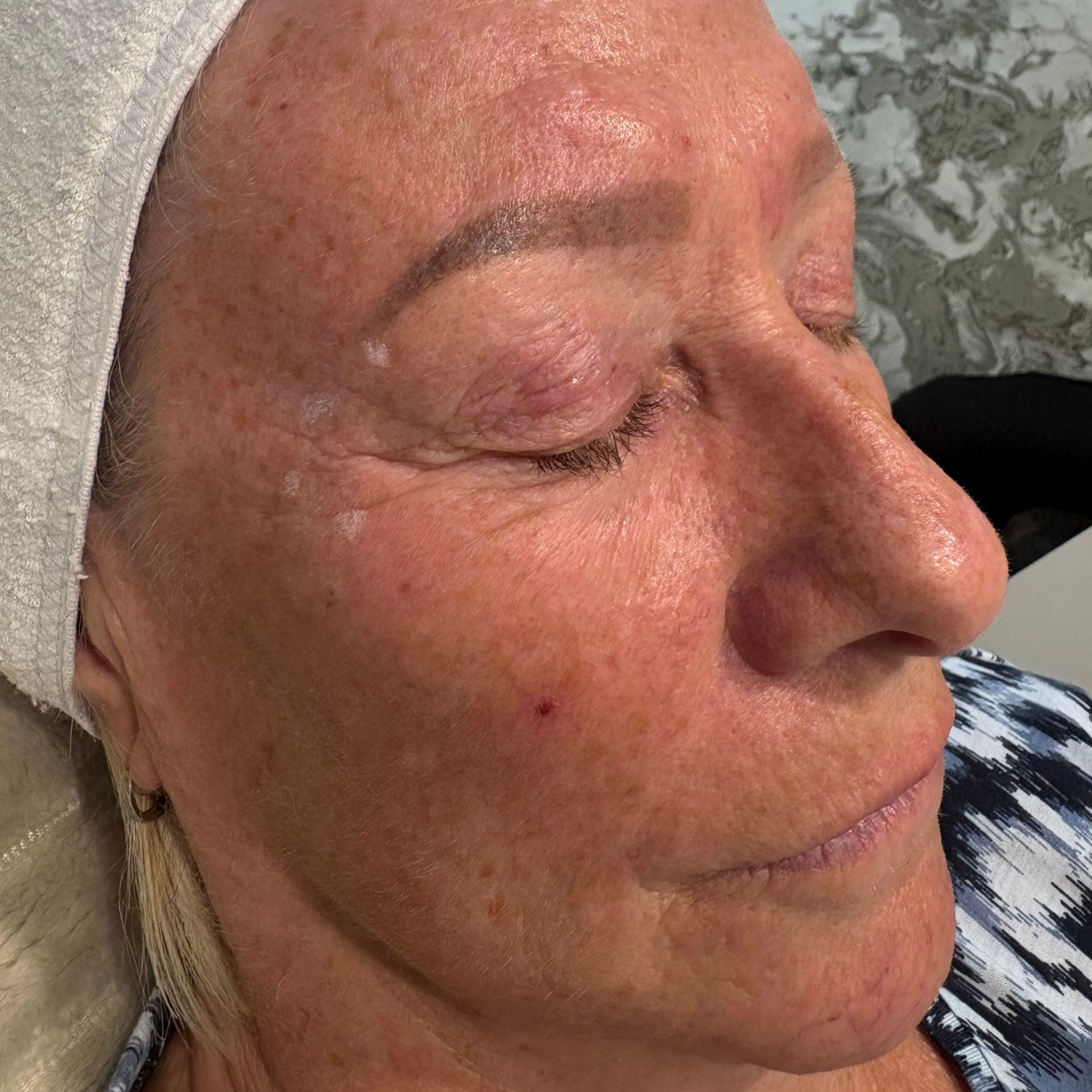 Aesthetics By Luisha | Anti-Wrinkle  In Derby, UK