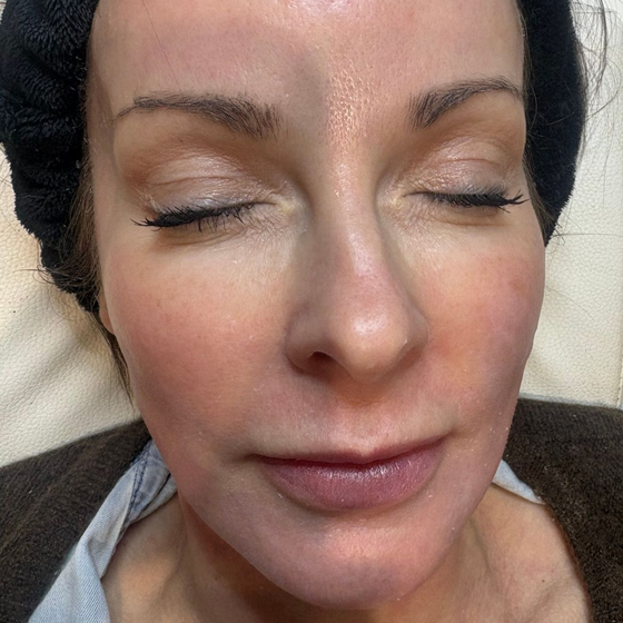 Aesthetics By Luisha | Polynucleotides In Derby, UK