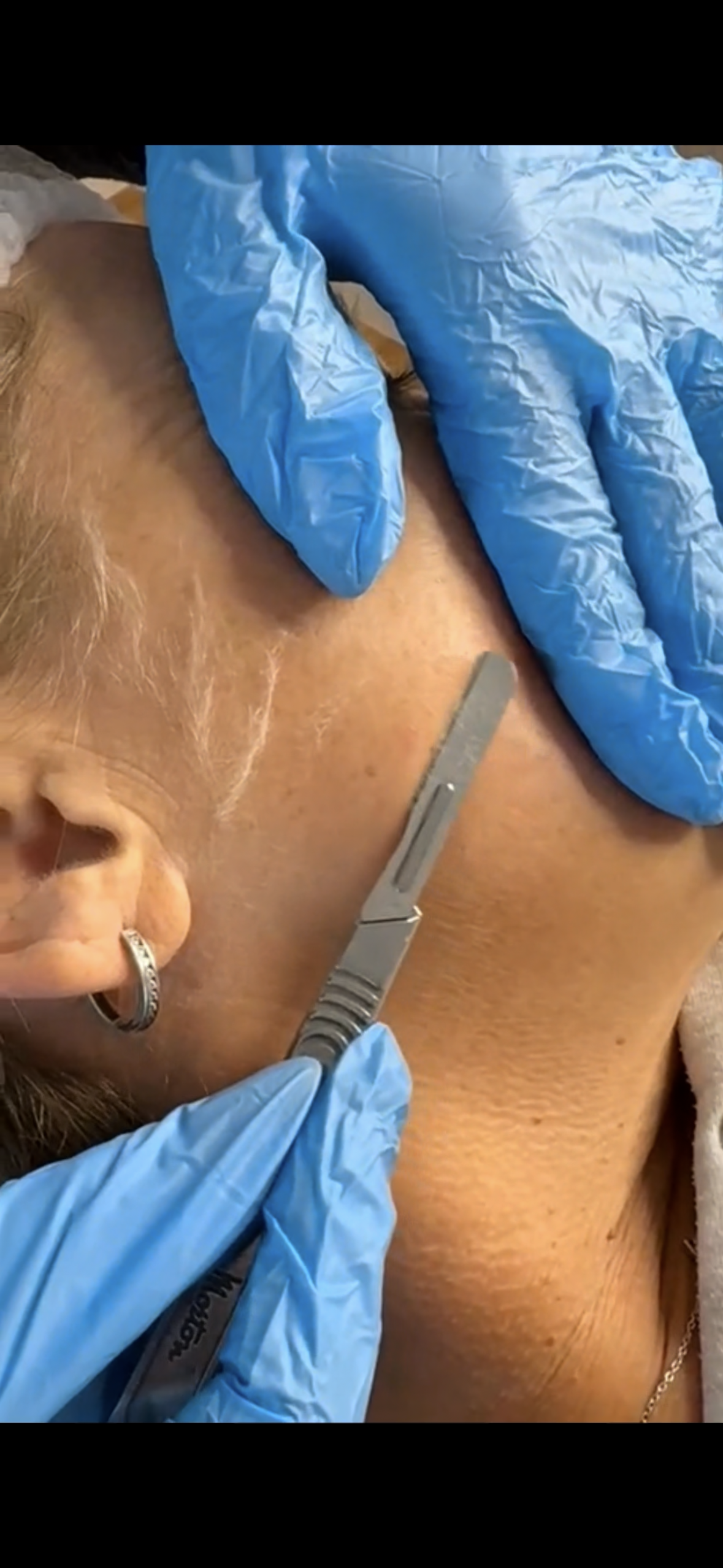 Aesthetics By Luisha | Dermal Filler In Derby, UK