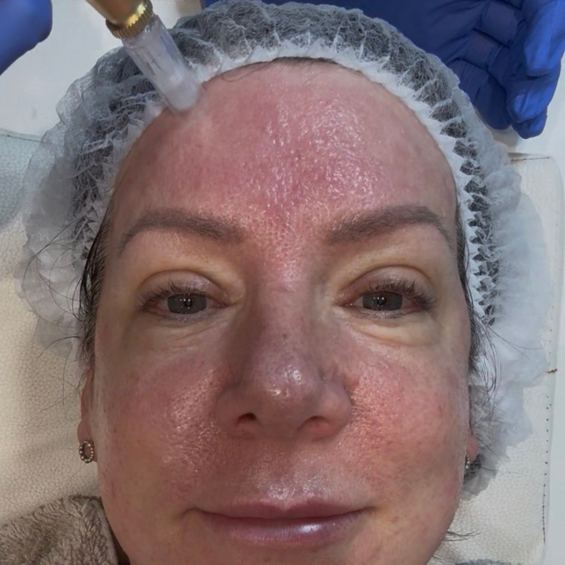 Aesthetics By Luisha | Dermal Filler In Derby, UK