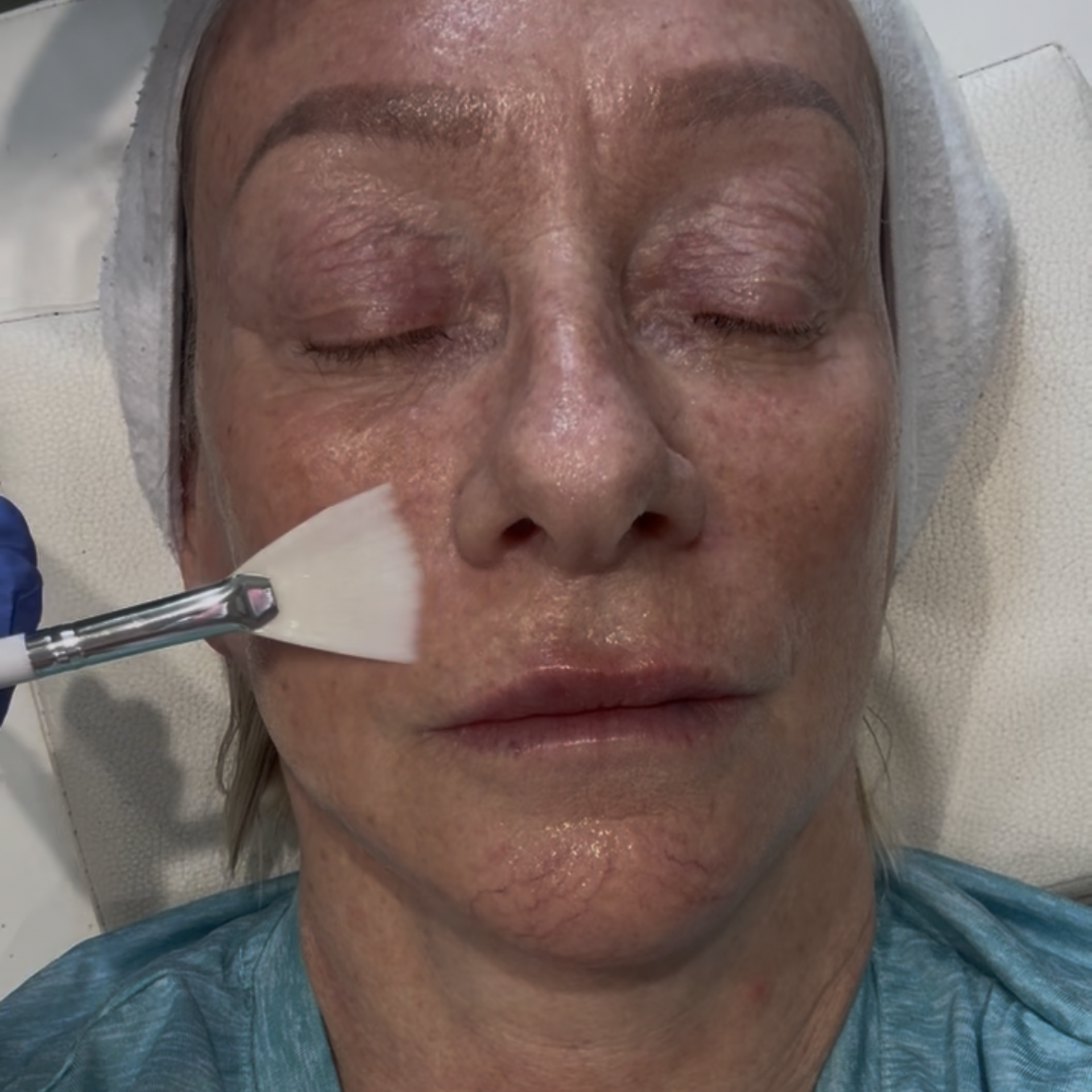 Aesthetics By Luisha | Dermal Filler In Derby, UK