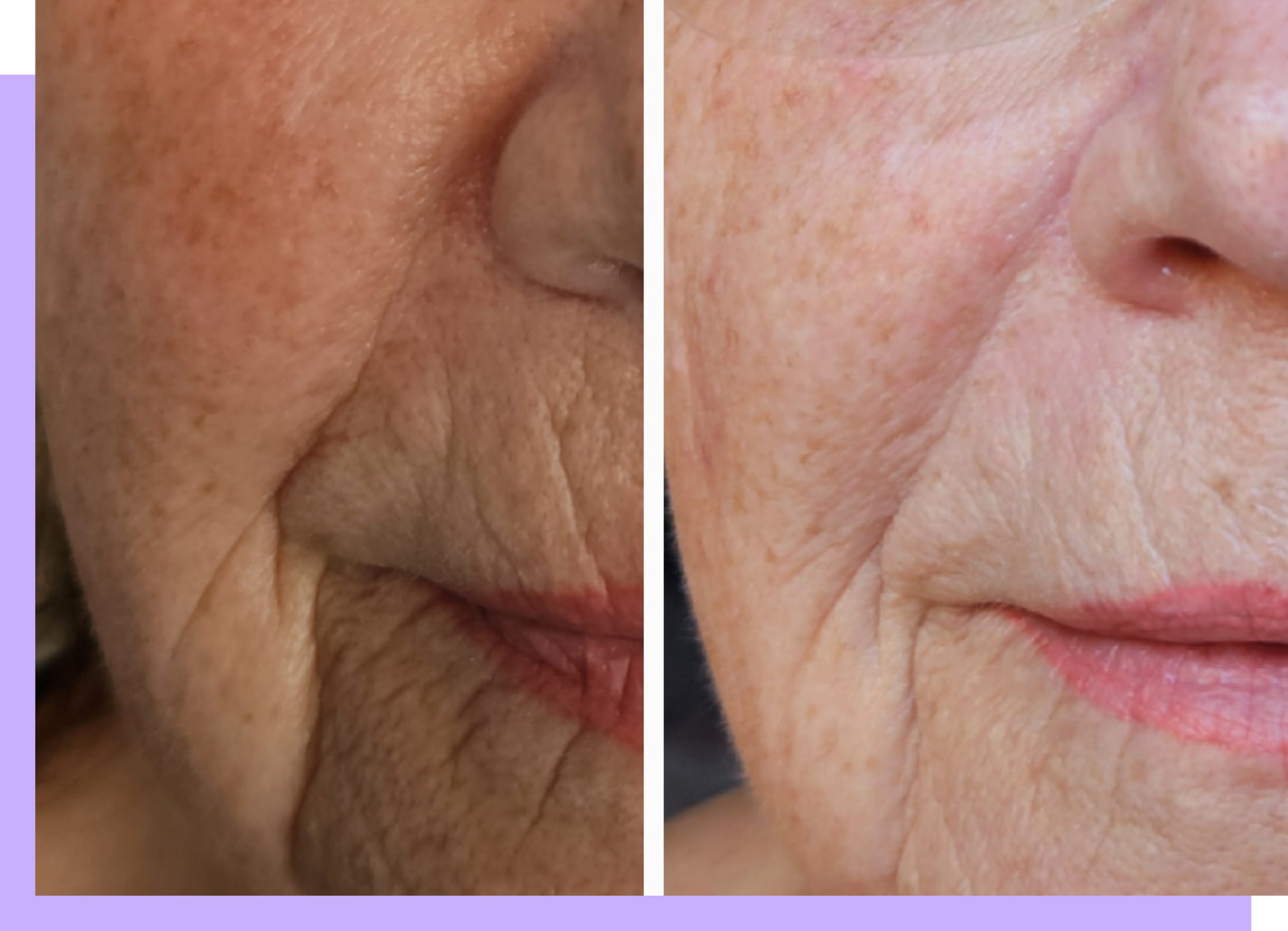 Ein Vorher-Nachher-Foto des Gesichts einer Frau mit Falten.