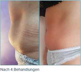 Ein Vorher-Nachher-Bild vom Bauch einer Frau