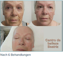 Ein Vorher-Nachher-Foto vom Gesicht einer Frau