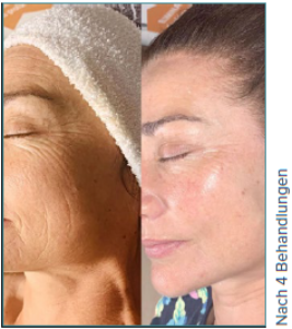 Ein Vorher-Nachher-Foto vom Gesicht einer Frau