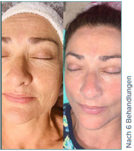 Ein Vorher-Nachher-Foto vom Gesicht einer Frau