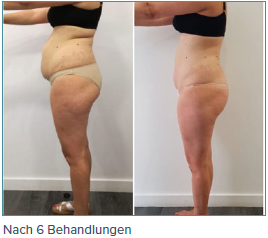 Ein Vorher-Nachher-Bild vom Bauch einer Frau
