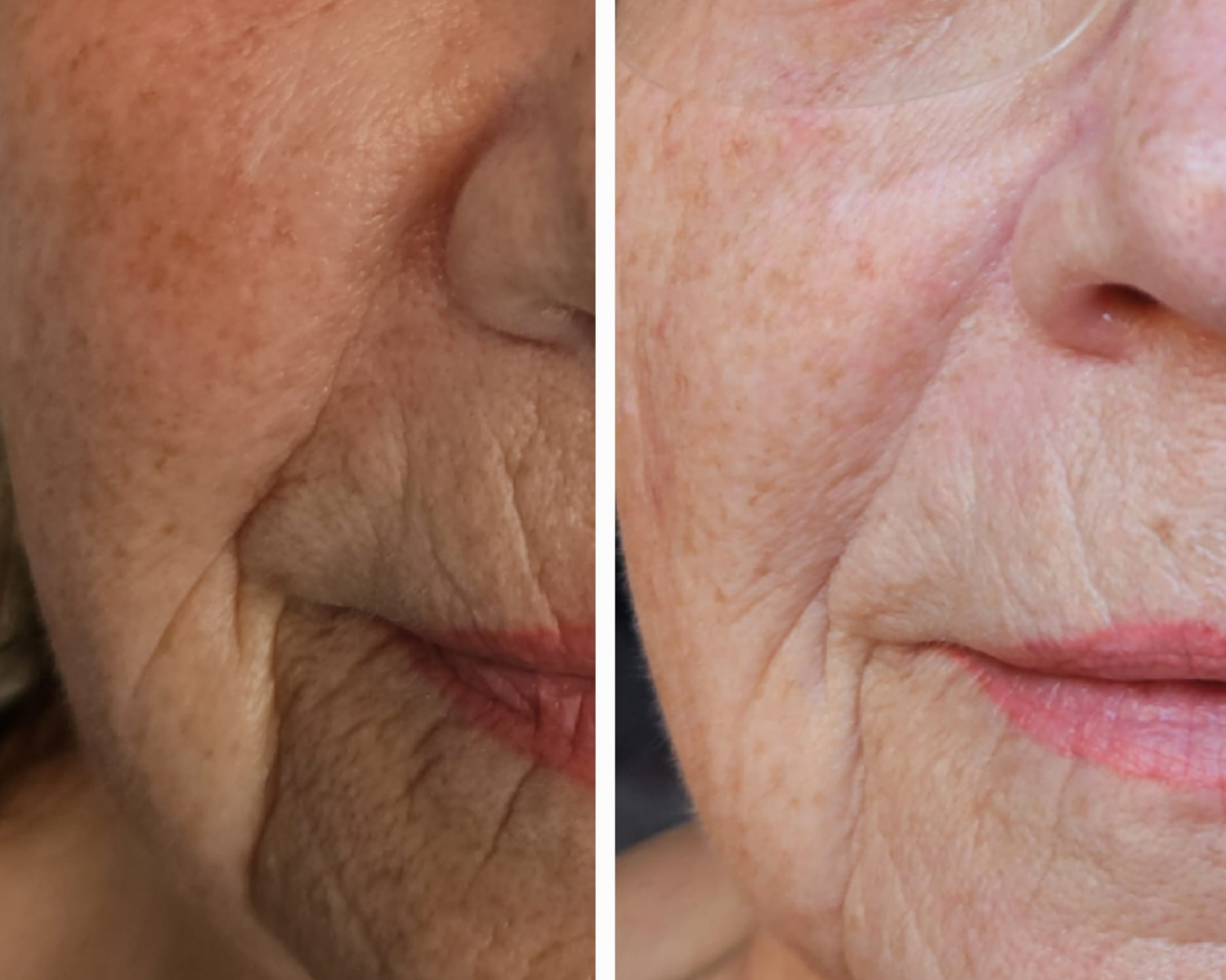 Ein Vorher-Nachher-Foto vom Gesicht einer älteren Frau.