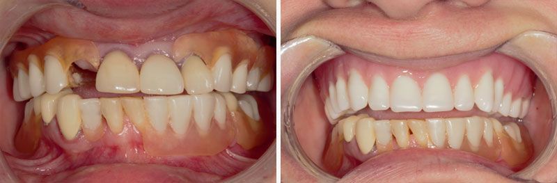 All-on-4 Dentures - Before & After