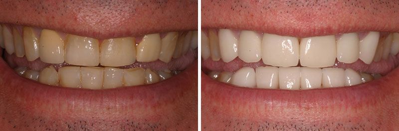 Smile Makeover - Before & After