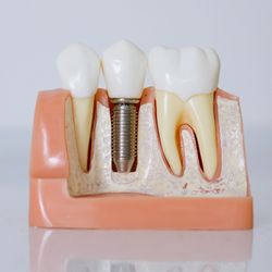 a model of a tooth with a dental implant in it