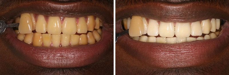 Teeth Whitening - Before & After