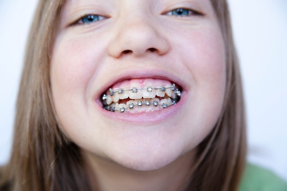 bambina con apparecchio ortodontico sulle arcate dentali