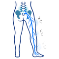 Lower body diagram showing sciatic nerve pain from lower back to leg, with blue nerve highlighted.
