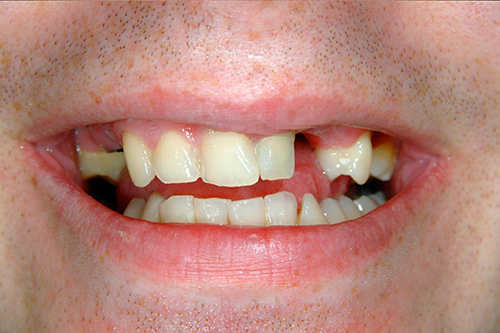Close-up of a person's mouth with several missing teeth, visible gums, and a slightly crooked smile.