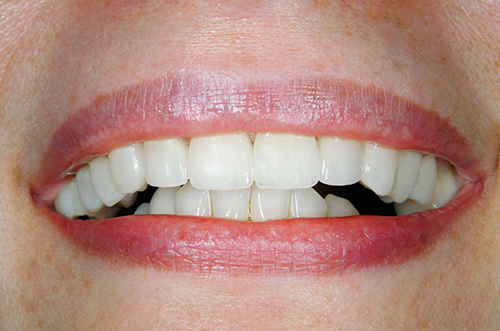 After Teeth Whitening