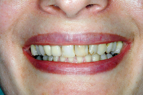 Before Teeth Whitening