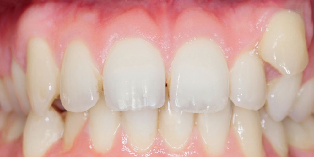 Before teeth whitening