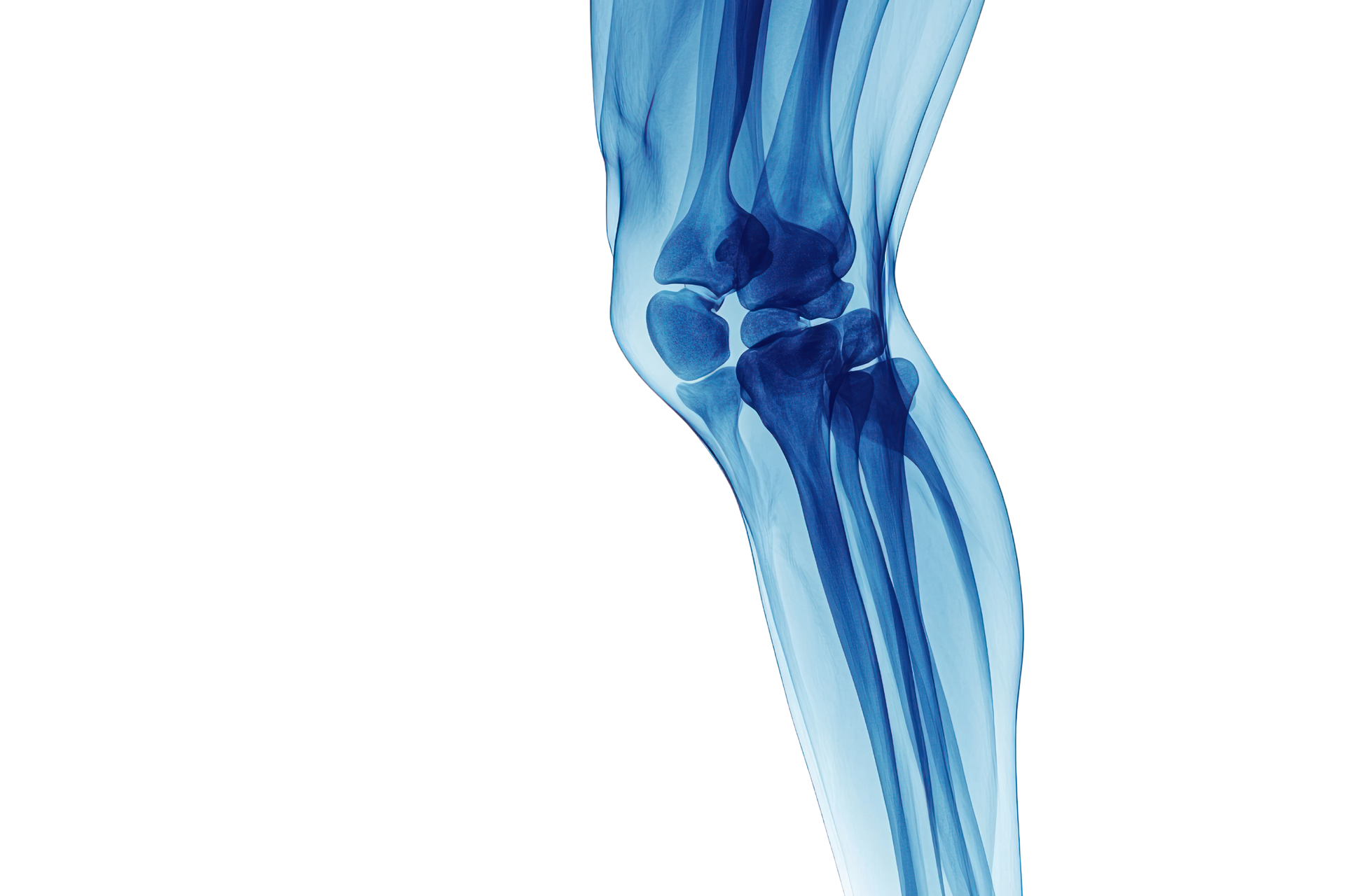 An x-ray of a person 's knee and leg