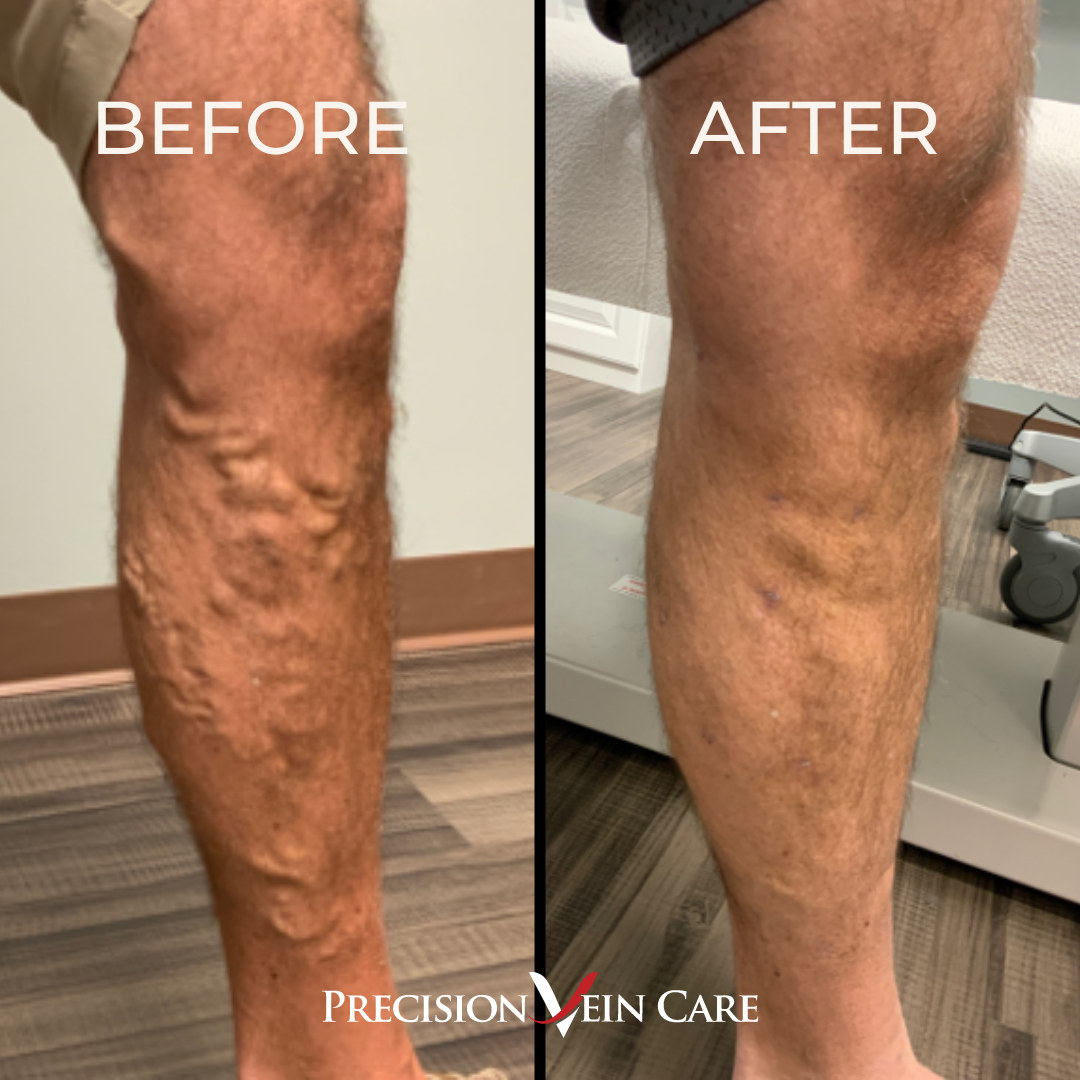 before and after vein treatment at precision vein care - real patient