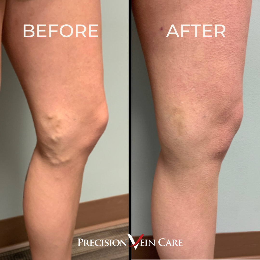 before and after vein treatment at precision vein care - real patient