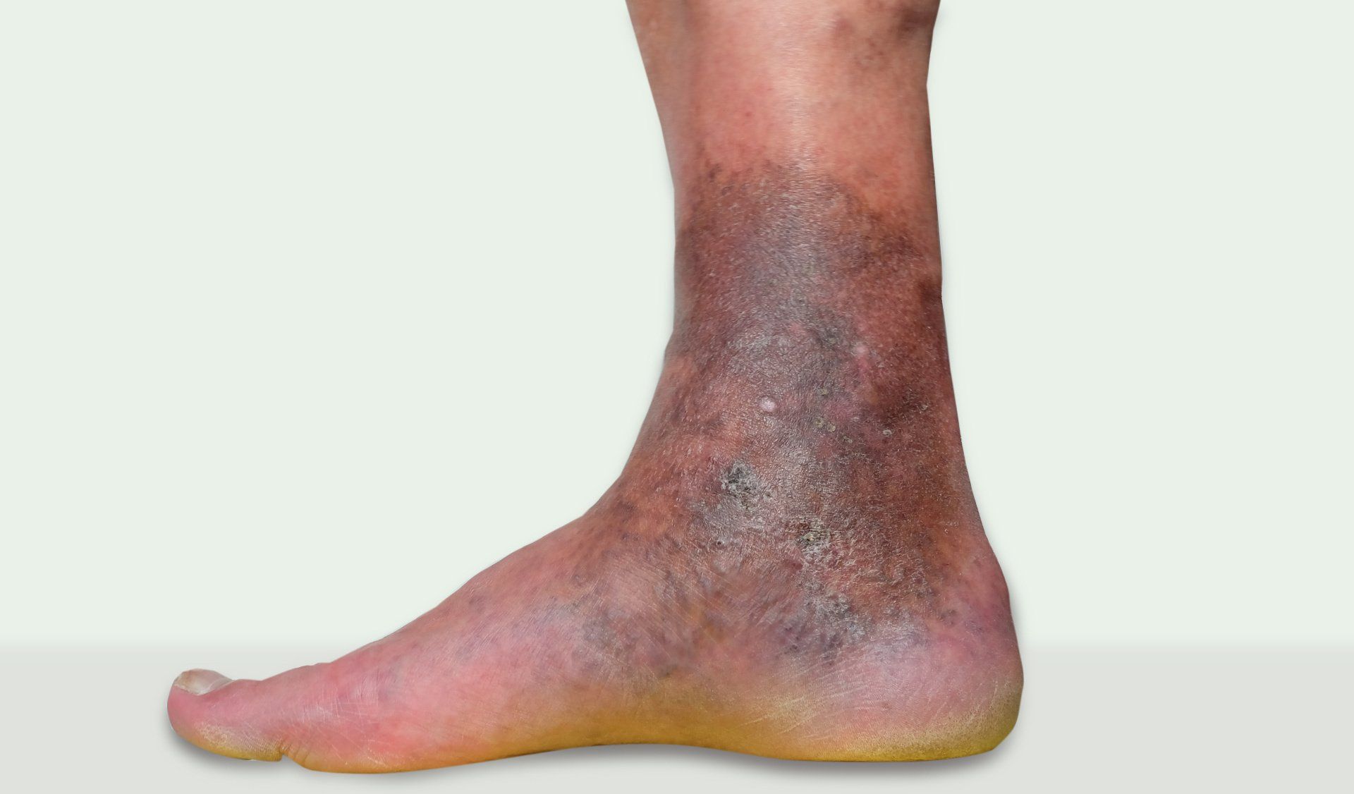 A close up of a person 's foot with varicose veins.