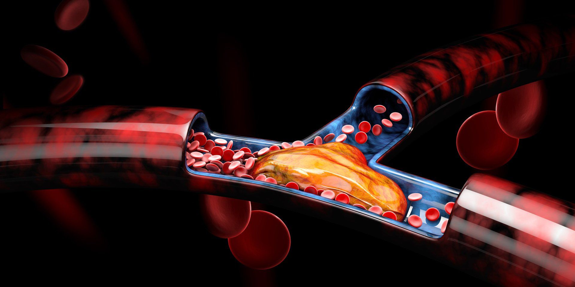 image of blood clot