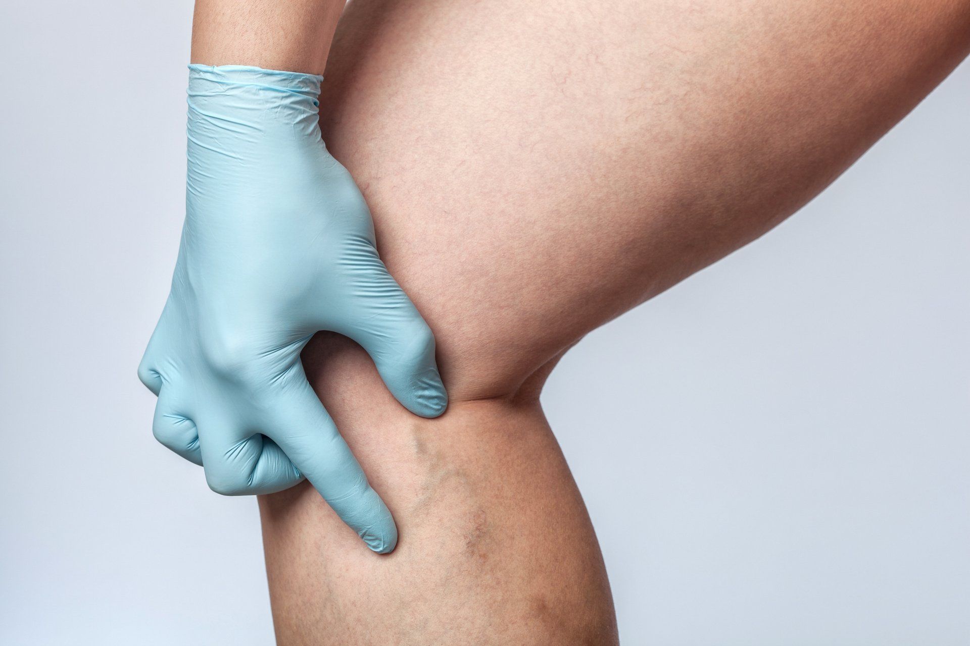 A person wearing gloves is pointing at a vein on their leg.