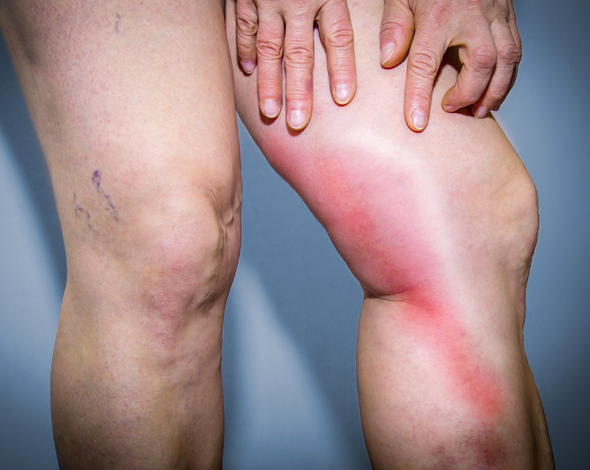 A woman is holding her knee in pain.